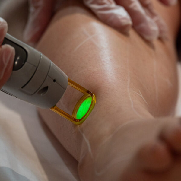 Winnipeg Laser Treatment on Leg