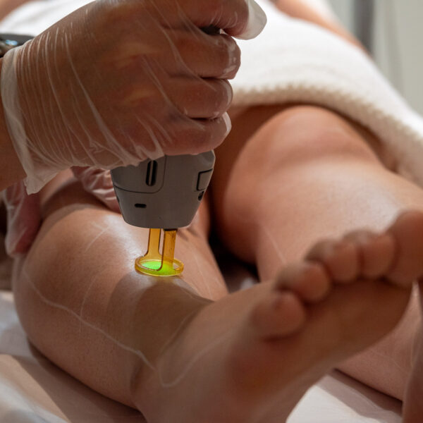 Winnipeg Laser Hair Removal Treatment on Leg