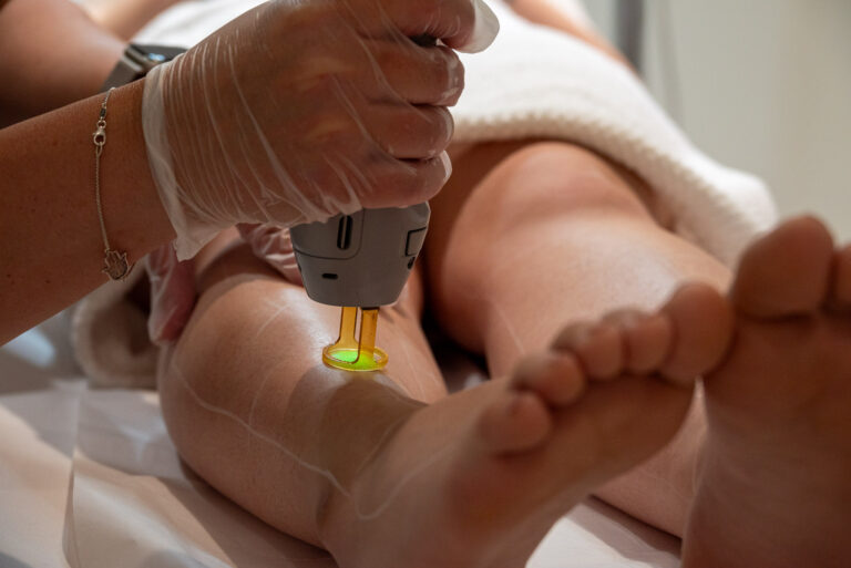 Winnipeg Laser Hair Removal Treatment on Leg