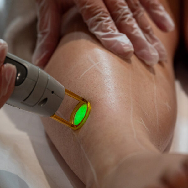 Laser Hair Removal Treatment on Leg