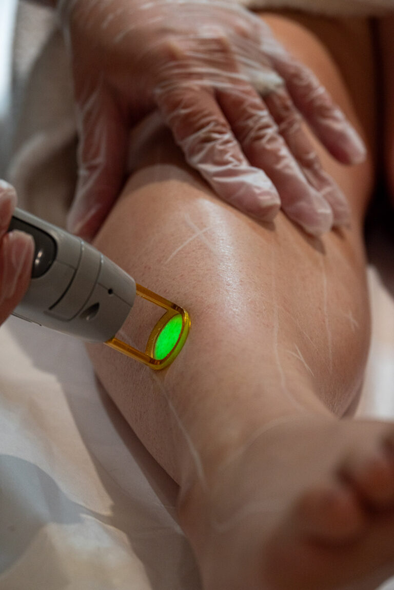Laser Hair Removal Treatment on Leg
