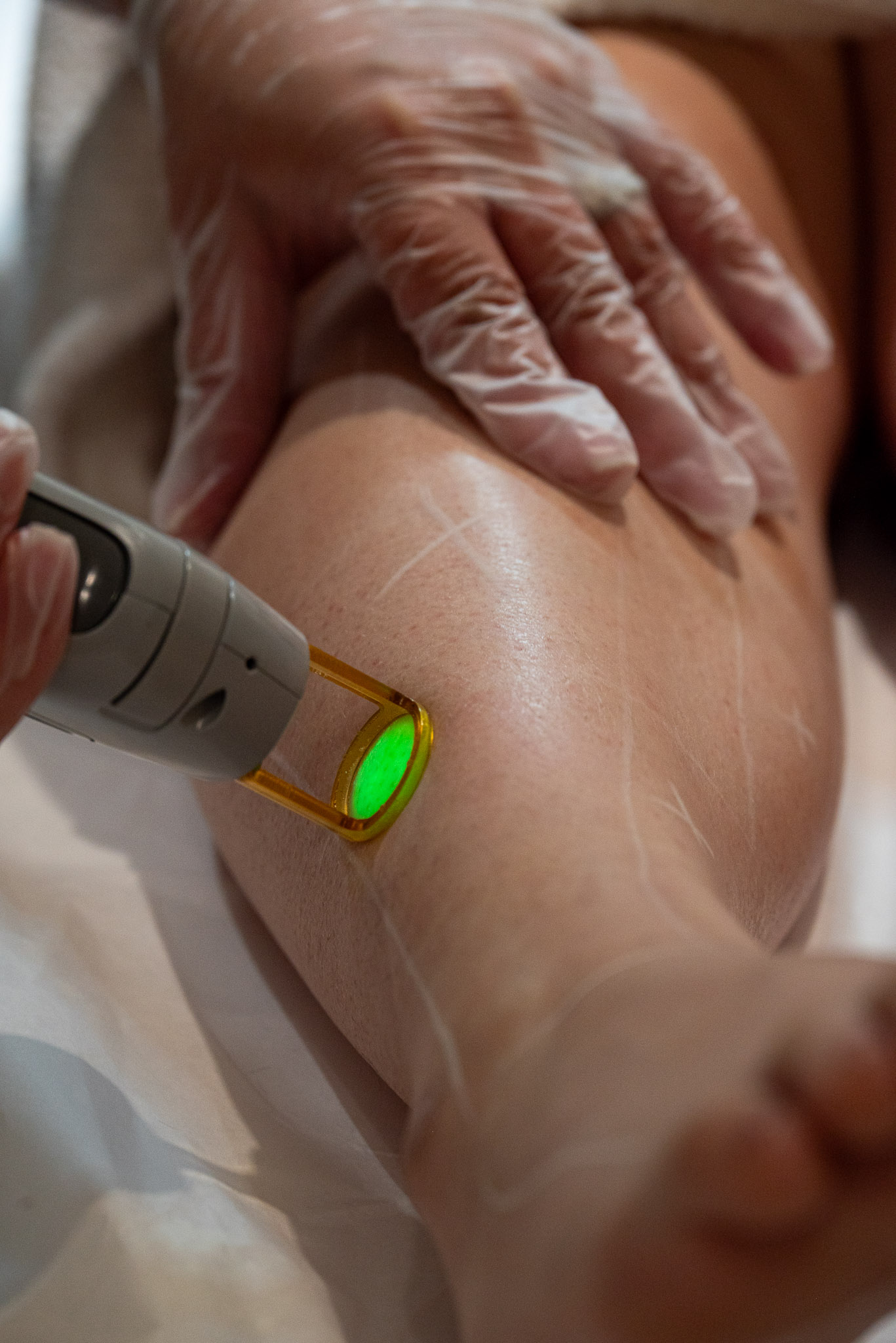 Read more about the article Laser Hair Removal: A Long-Term Solution for Unwanted Hair